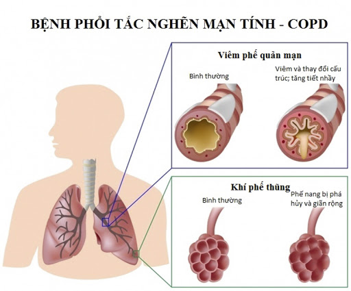 9 ĐỐI TƯỢNG DỄ BỊ COVID -19 TẤN CÔNG